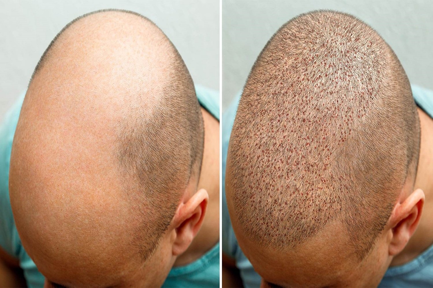 Hair Transplantation